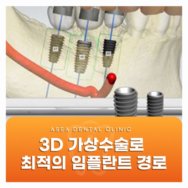 경주임플란트, 3D 네비게이션 가상수술로 안전하게 식립하는 방법