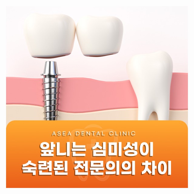 경주 앞니임플란트, 심미성을 살리는 전문의 노하우
